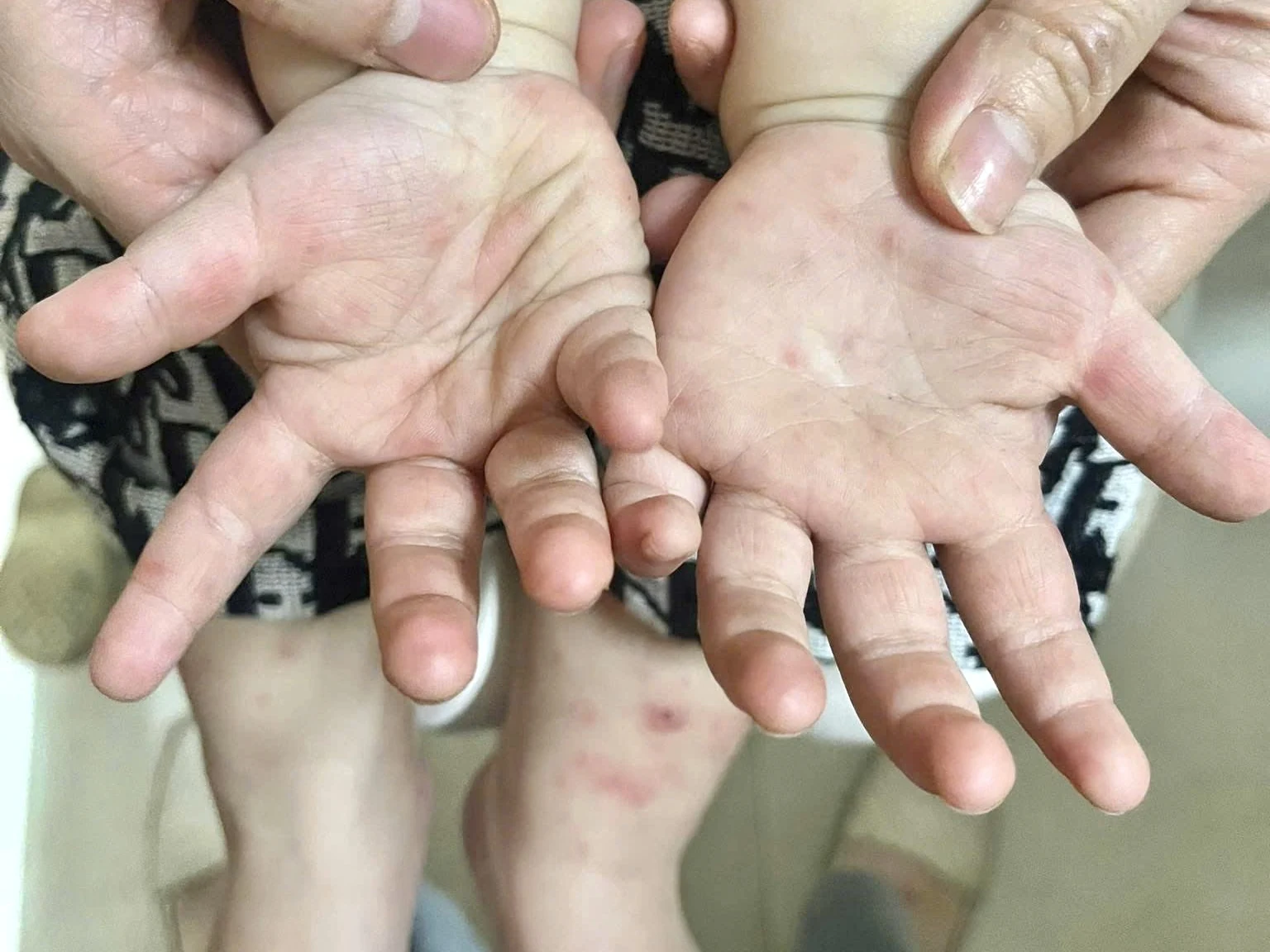 Phòng, chống dịch bệnh cho trẻ trong mùa nắng nóng