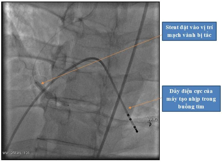 Gần 2 giờ liên tục ép tim, sốc điện cứu sống người bệnh nhồi máu cơ tim ngừng tuần hoàn