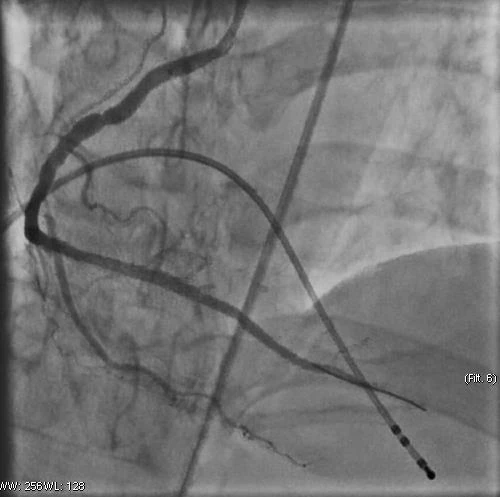 Gần 2 giờ liên tục ép tim, sốc điện cứu sống người bệnh nhồi máu cơ tim ngừng tuần hoàn
