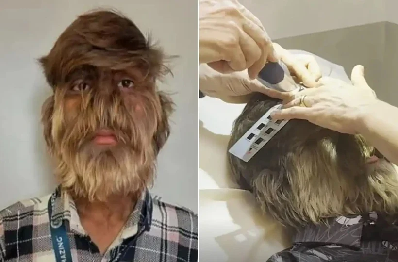 Thiếu niên được trao kỷ lục thế giới Guinness vì mắc hội chứng “người sói” kỳ lạ