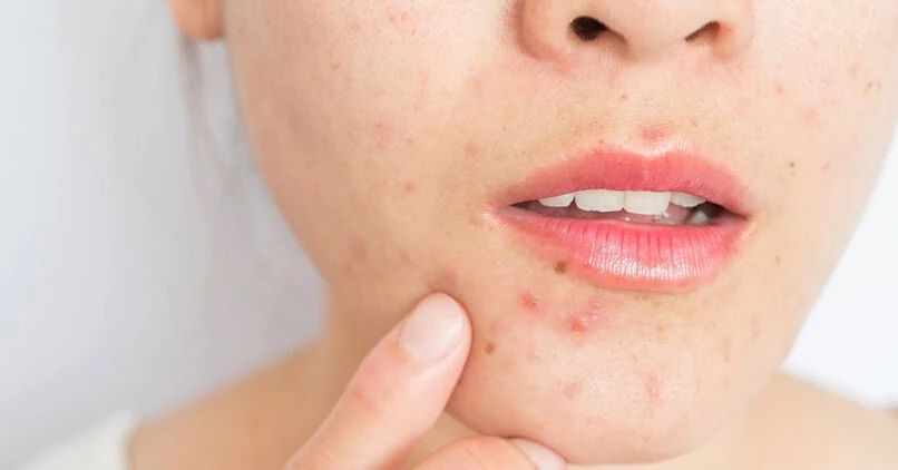 Bị nổi mụn mãi không hết - Đừng vội bỏ qua bài viết này!