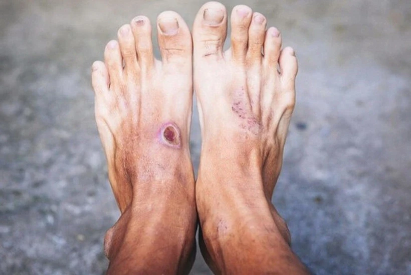 Bước đột phá mới trong điều trị bệnh tiểu đường tuýp 1