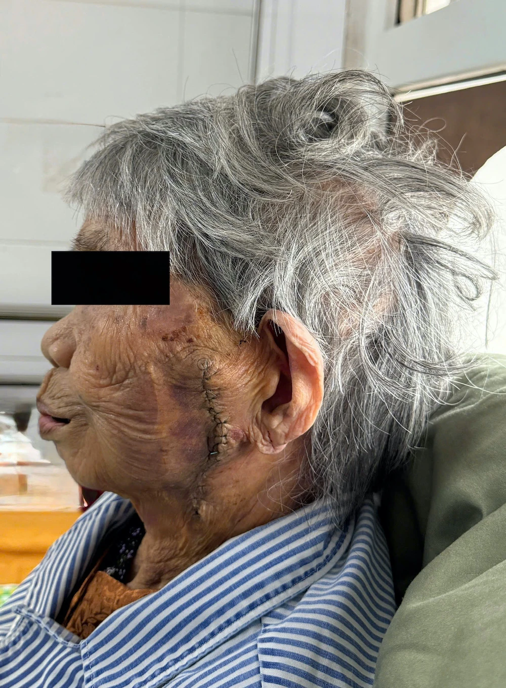 Bệnh viện Ung bướu Thanh Hóa phẫu thuật thành công khối ung thư khổng lồ vùng mặt cho cụ bà 99 tuổi