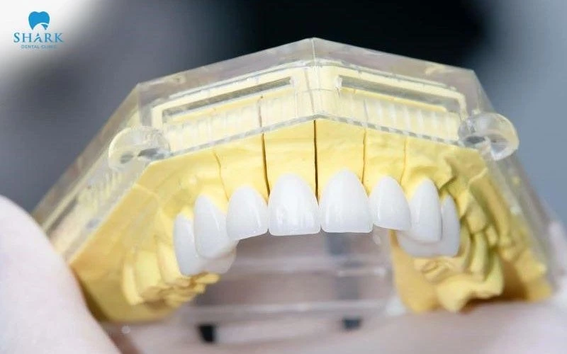 Bọc răng sứ Cercon XT - Giải pháp phục hình thẩm mỹ cao cấp