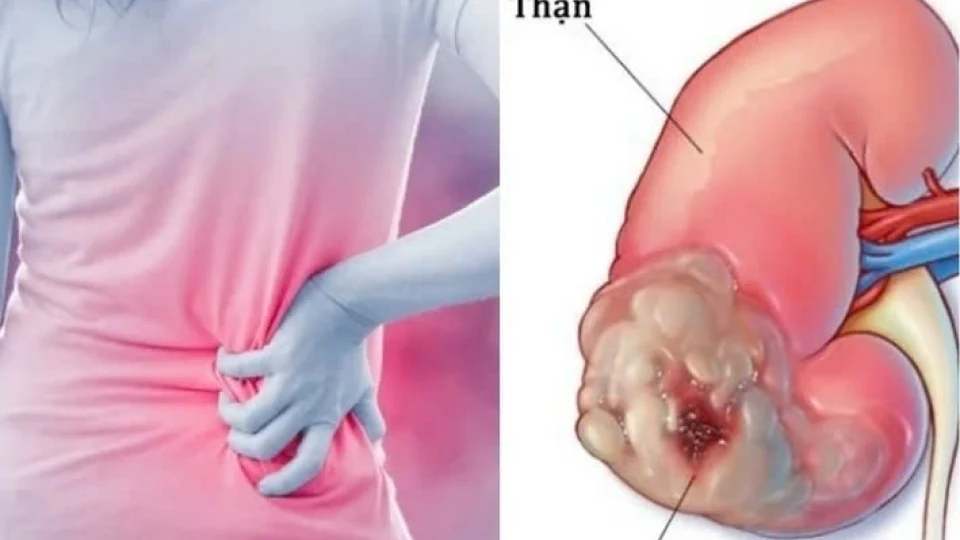 Dấu hiệu thầm lặng cảnh báo ung thư thận