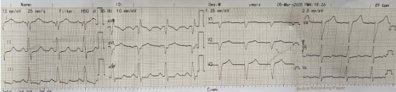 Hiệu quả từ phương pháp cấy máy tạo nhịp 3 buồng trong điều trị suy tim