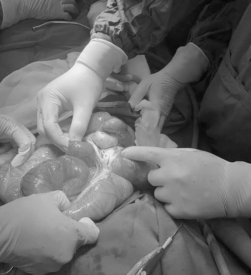 Phẫu thuật cấp cứu thành công bệnh nhân tắc ruột do u đại tràng