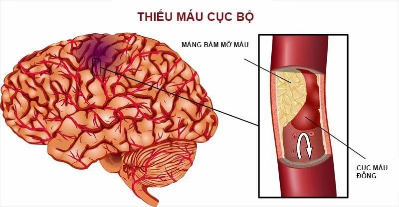 Cách phòng ngừa cục máu đông
