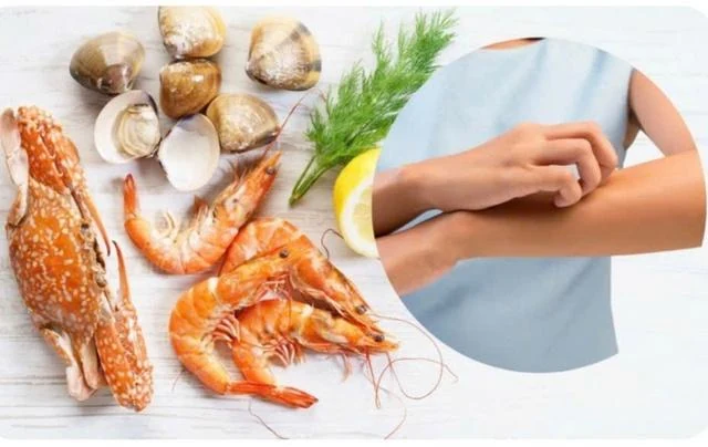 Đi du lịch biển, cần chú ý 6 loại hải sản dễ gây dị ứng nhất