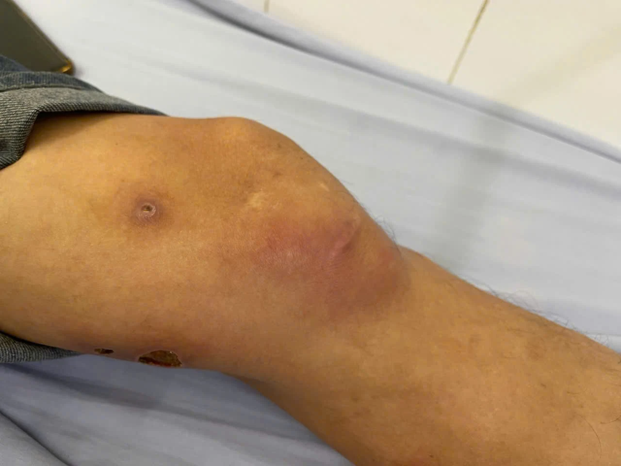 Phát hiện một bệnh nhân nhiễm giun rồng, loại ký sinh trùng hiếm gặp