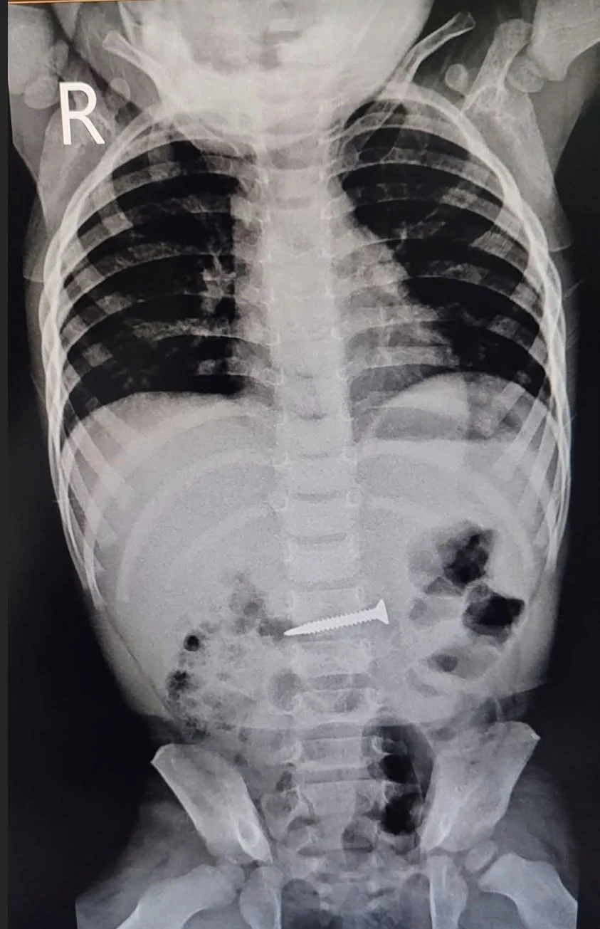 Cứu sống bé trai 2 tuổi nuốt đinh vít