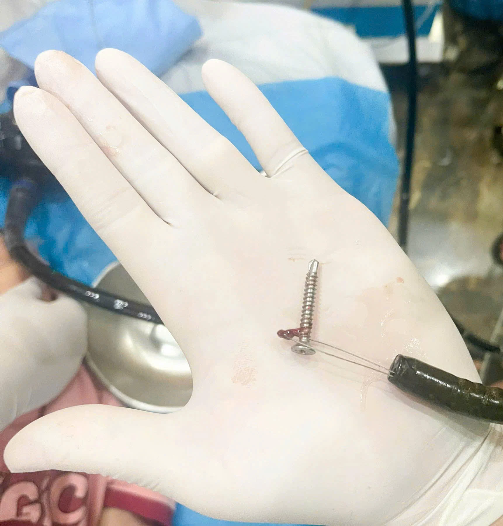 Cứu sống bé trai 2 tuổi nuốt đinh vít