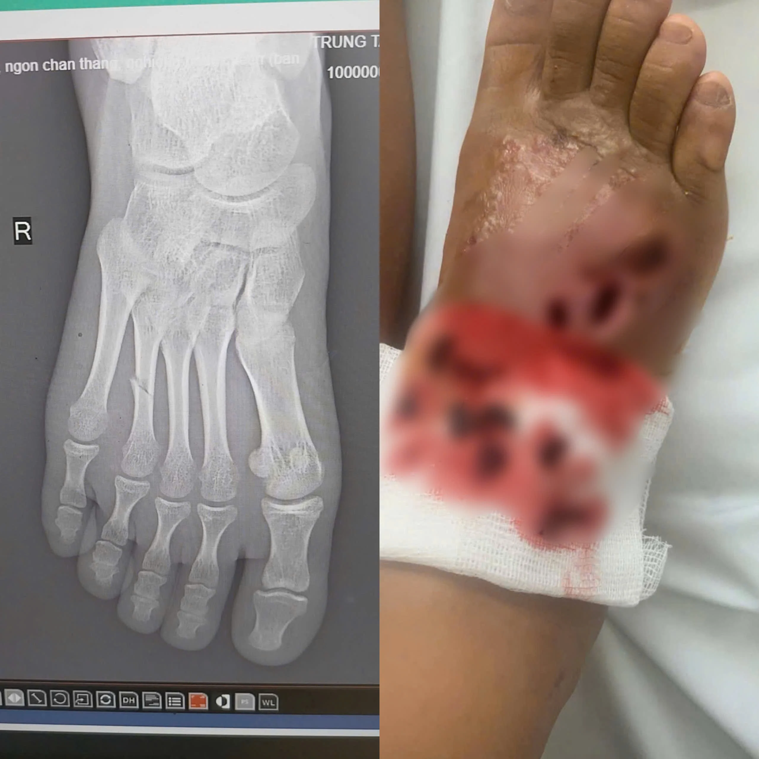 Cảnh báo nhiễm trùng nặng do bó thuốc nam điều trị gãy xương