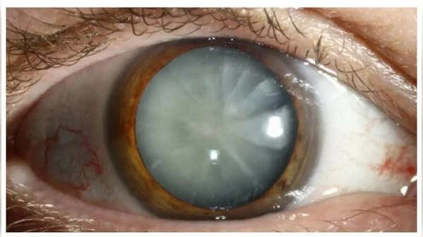 Bệnh tiểu đường ảnh hưởng đến mắt như thế nào, có phòng ngừa được không?