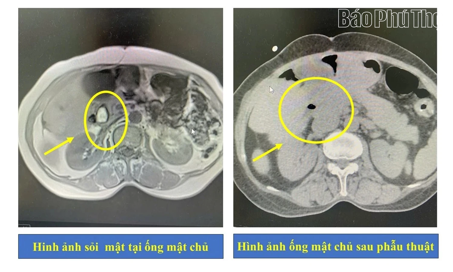 Kịp thời cứu chữa sỏi mật gây tắc ống mật và giun trong đường mật cho người bệnh