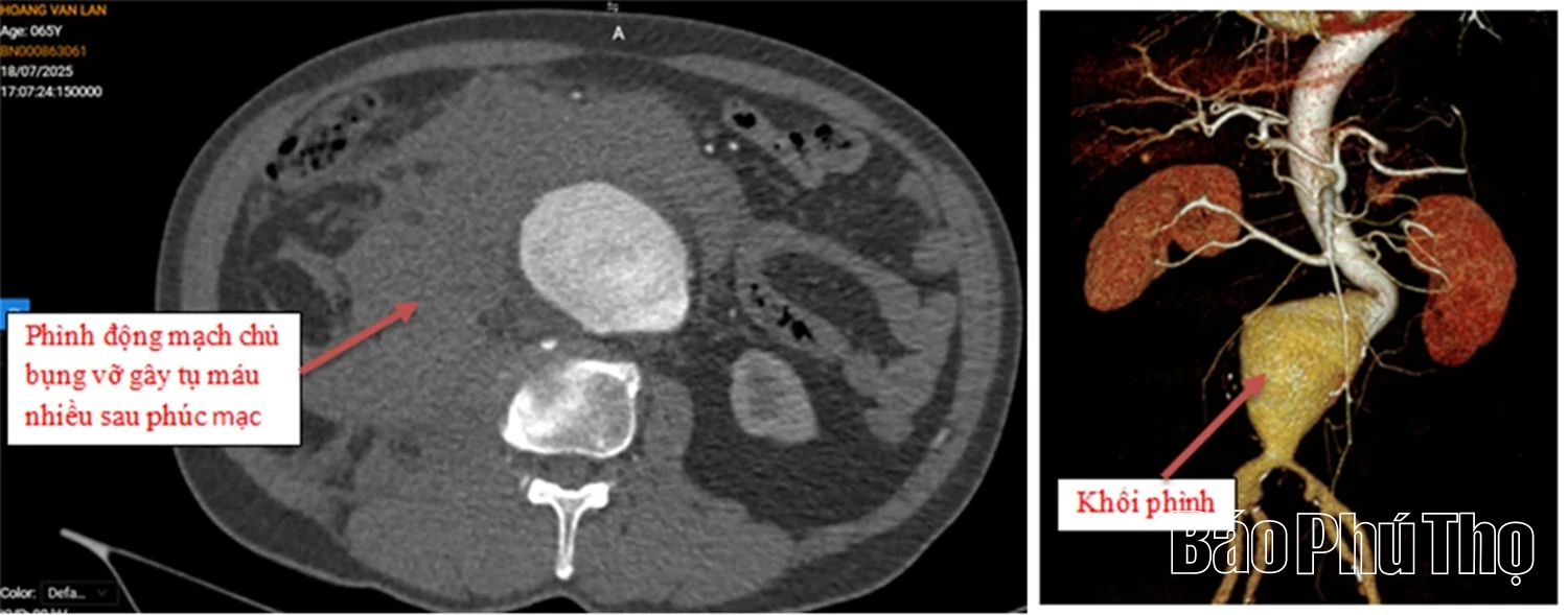 Cấp cứu người bệnh nguy kịch do vỡ phình động mạch chủ bụng