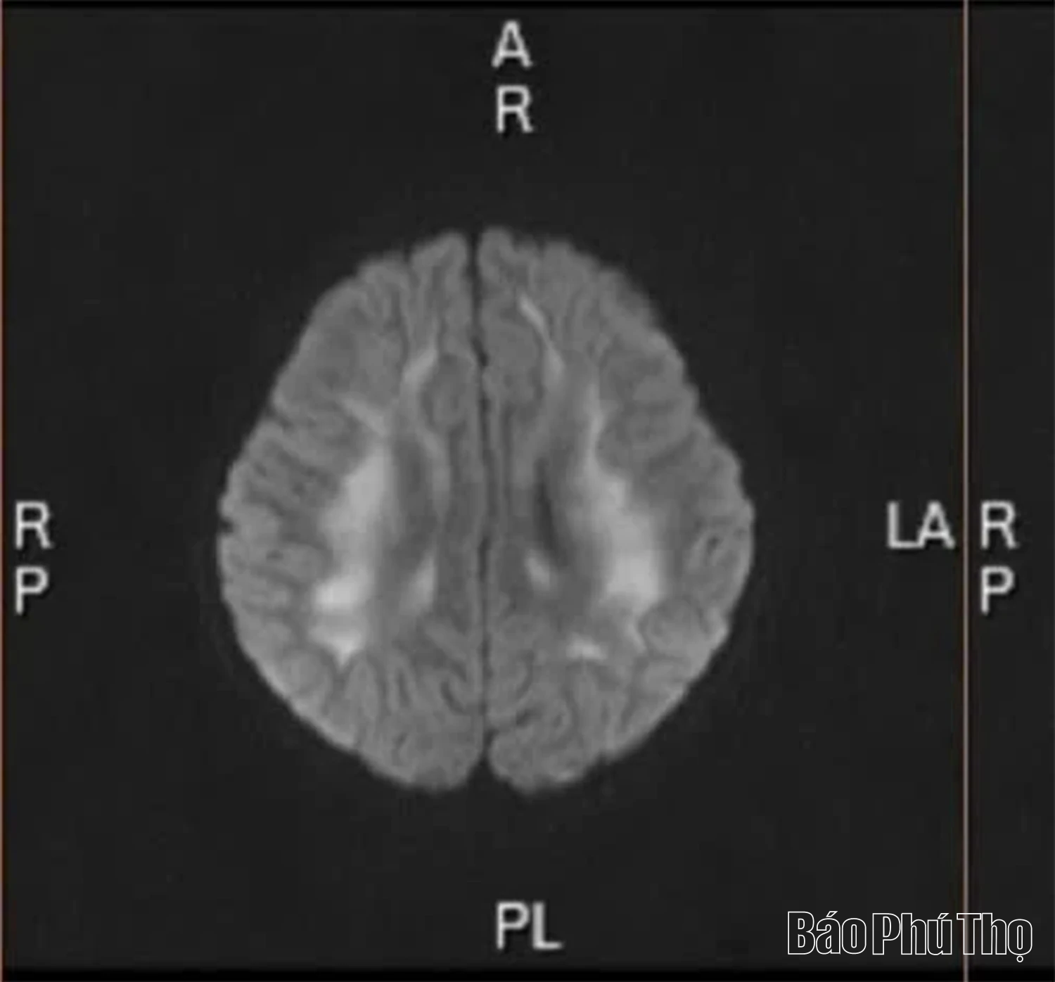 Thuốc lá điện tử - hiểm họa khôn lường với thế hệ trẻ