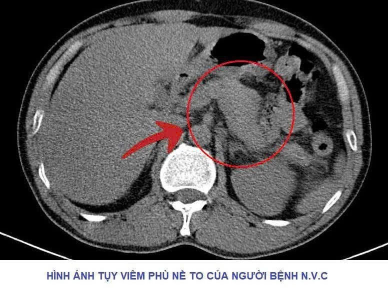 Cảnh báo nguy cơ viêm tụy cấp do lạm dụng rượu bia – Câu chuyện từ một ca cấp cứu tại Bệnh viện Đa khoa tỉnh Phú Thọ