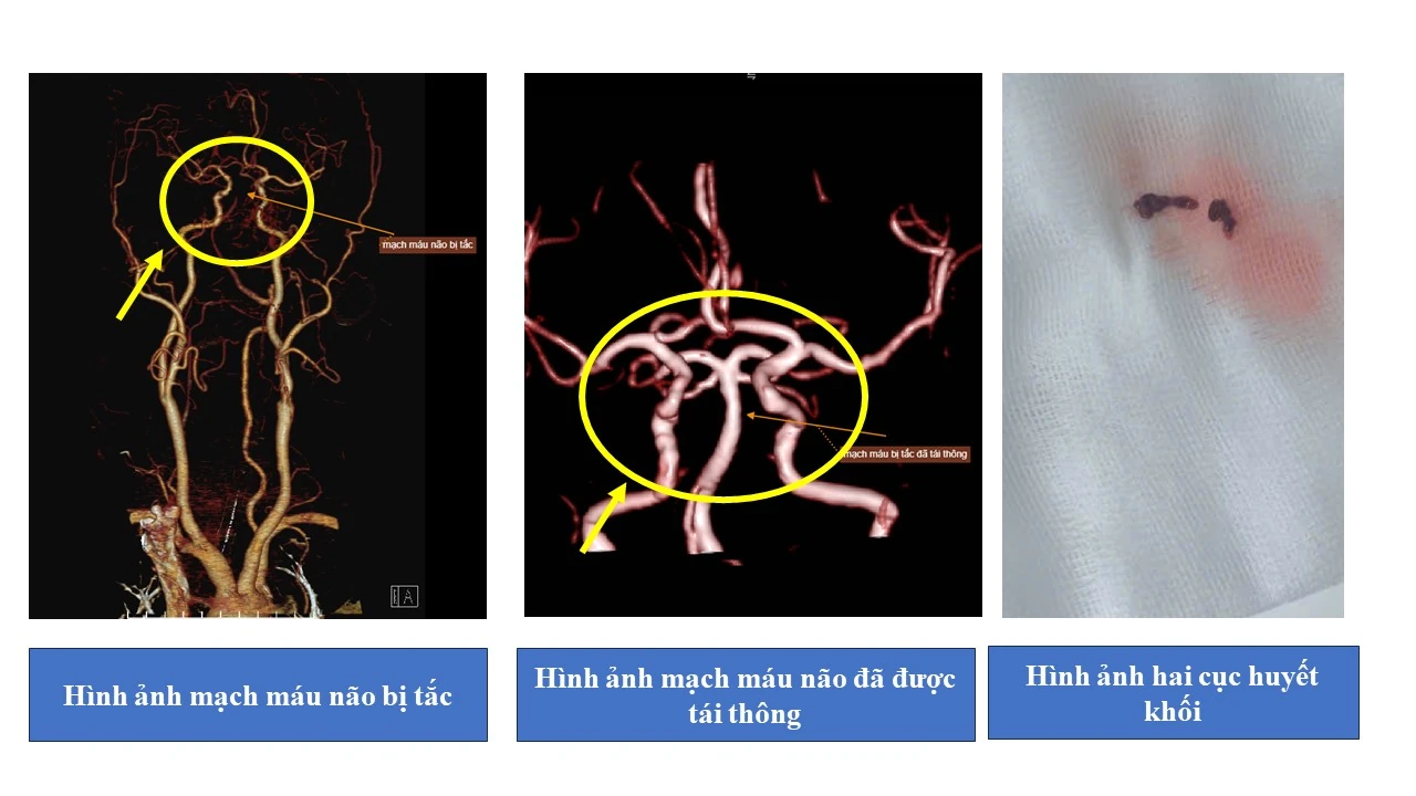 Kịp thời cấp cứu nguời bệnh trong giờ vàng