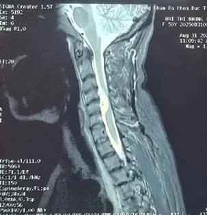 Bệnh viện Đa khoa Hòa Bình phẫu thuật thành công ca mổ hiếm u tủy sống vùng cổ
