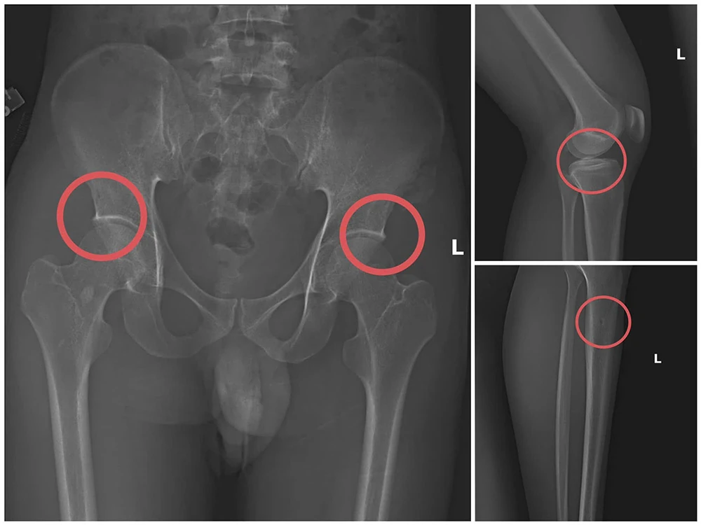 Triệt phá đường dây tự đục vỡ xương khớp, gây thương tích giả nhằm chiếm đoạt tiền bảo hiểm nhân thọ