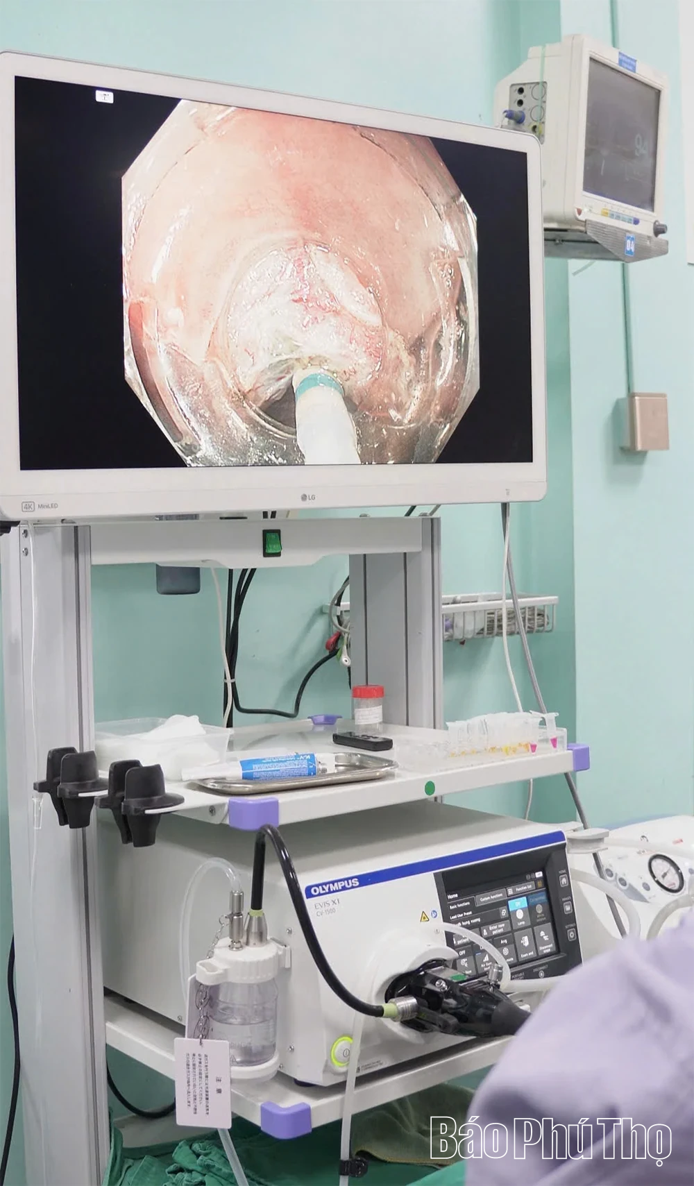 Lần đầu cắt khối u 10cm qua nội soi không cần phẫu thuật mổ mở