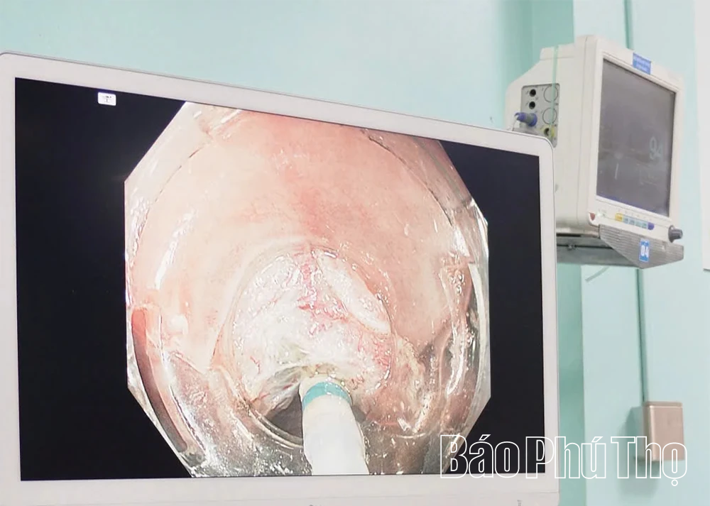 Lần đầu cắt khối u 10cm qua nội soi không cần phẫu thuật mổ mở