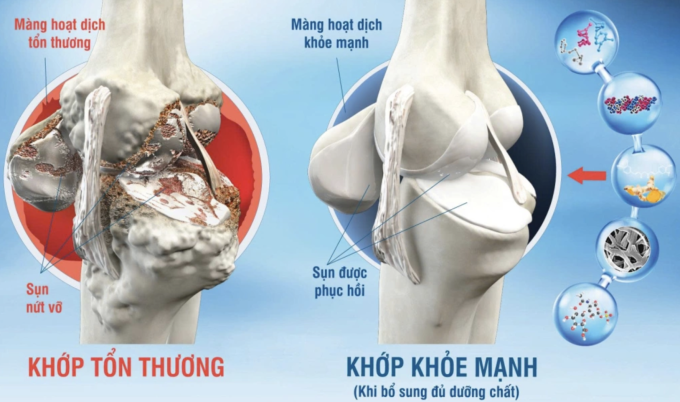 5 khớp trên cơ thể dễ bị thoái hóa