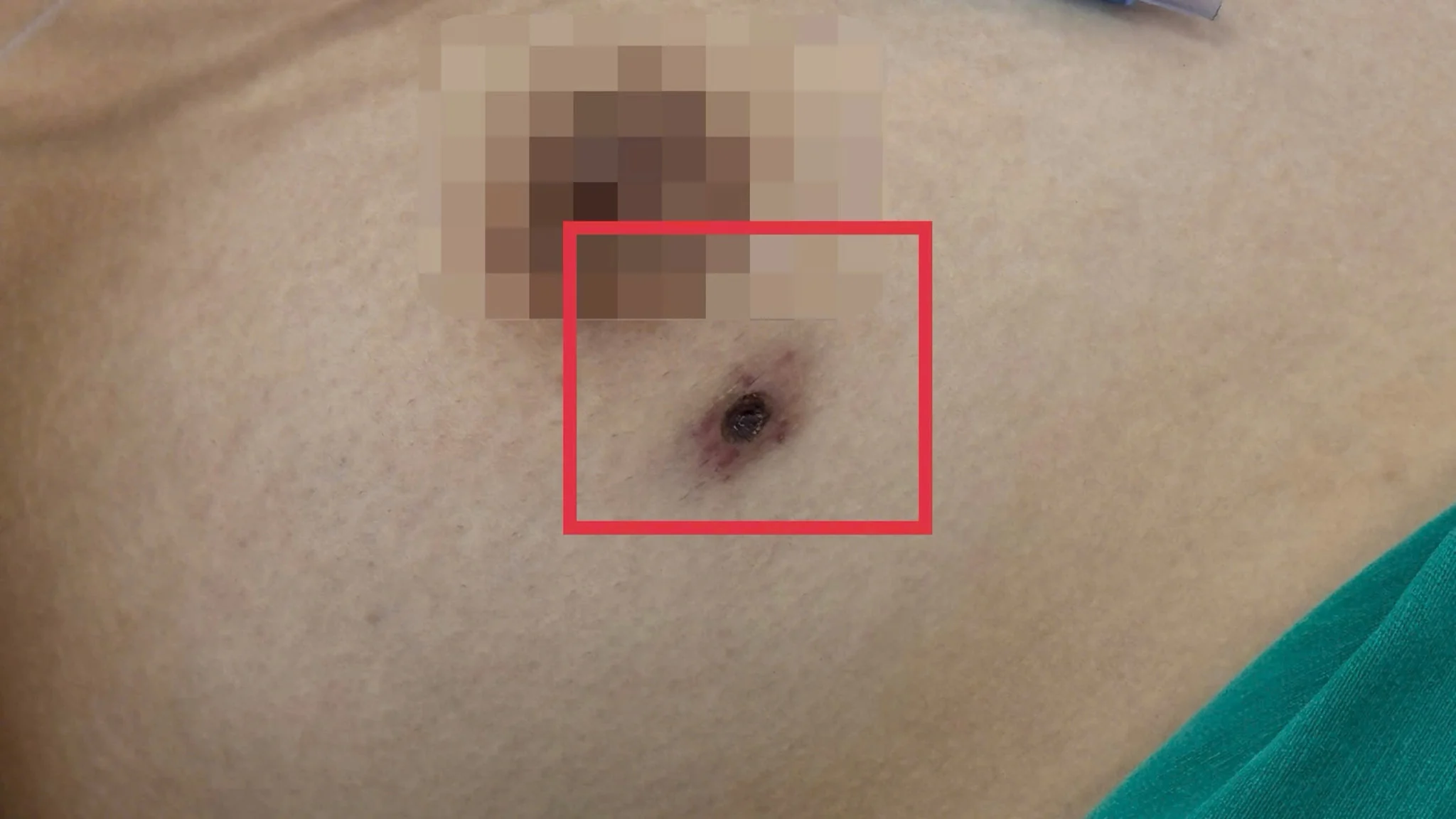 Cẩn trọng với vết đốt hoặc vết loét, phòng tránh sốc nhiễm khuẩn