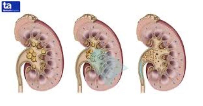 Nam Phi: Lần đầu tiên phẫu thuật lấy thận từ người hiến tặng bằng robot