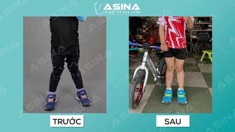 Làm thế nào để phân biệt chân chữ X sinh lý và chân chữ X bệnh lý?