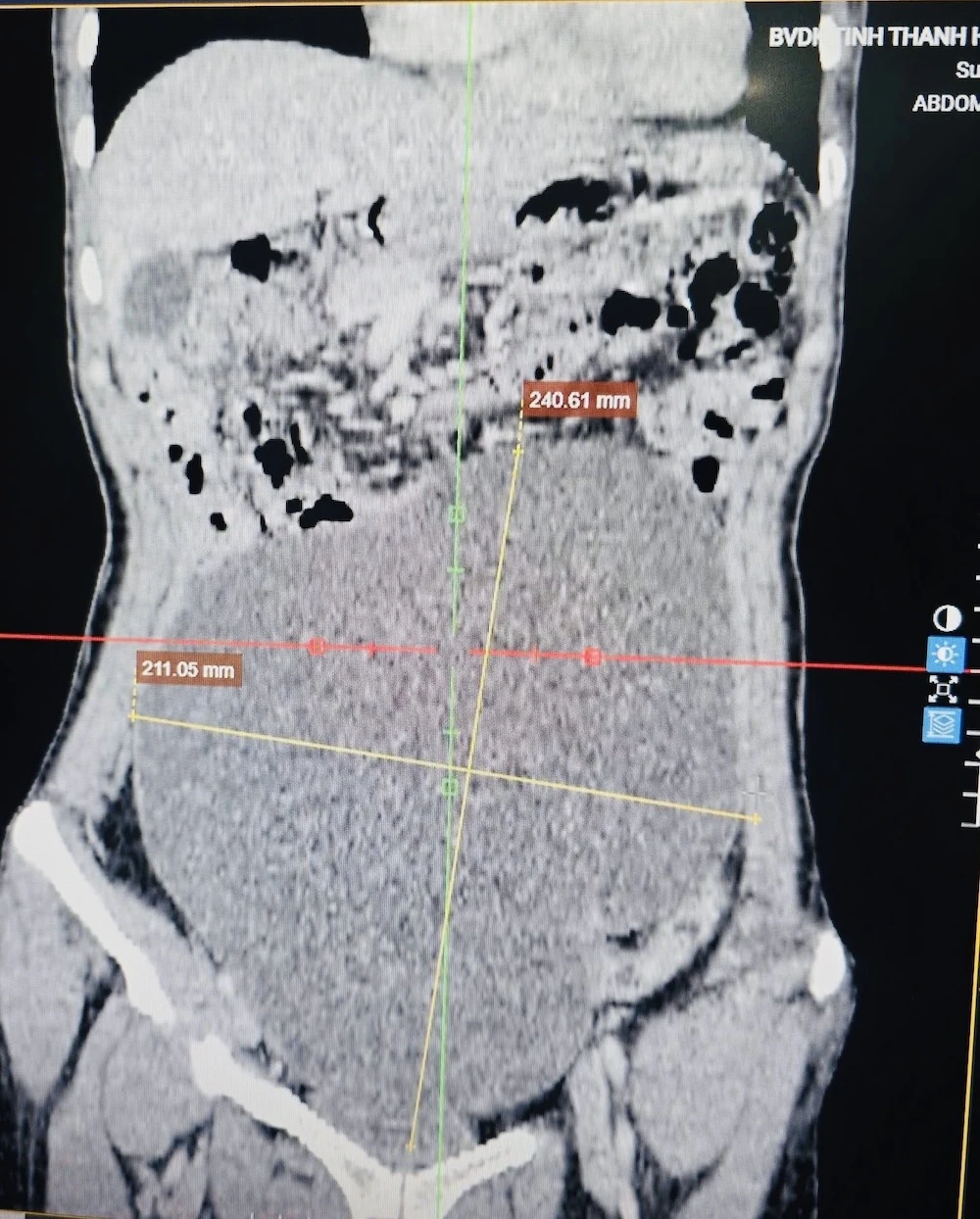 Bác sĩ phẫu thuật loại bỏ khối u buồng trứng gần 3kg