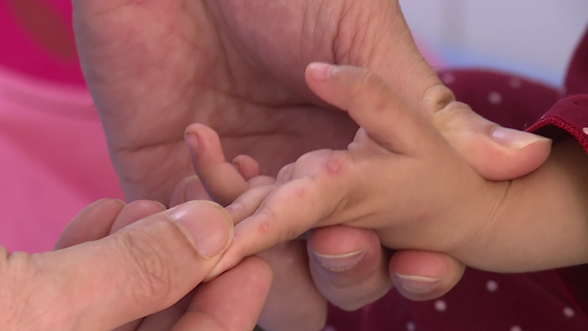 Gia tăng ca mắc tay chân miệng ở trẻ nhỏ