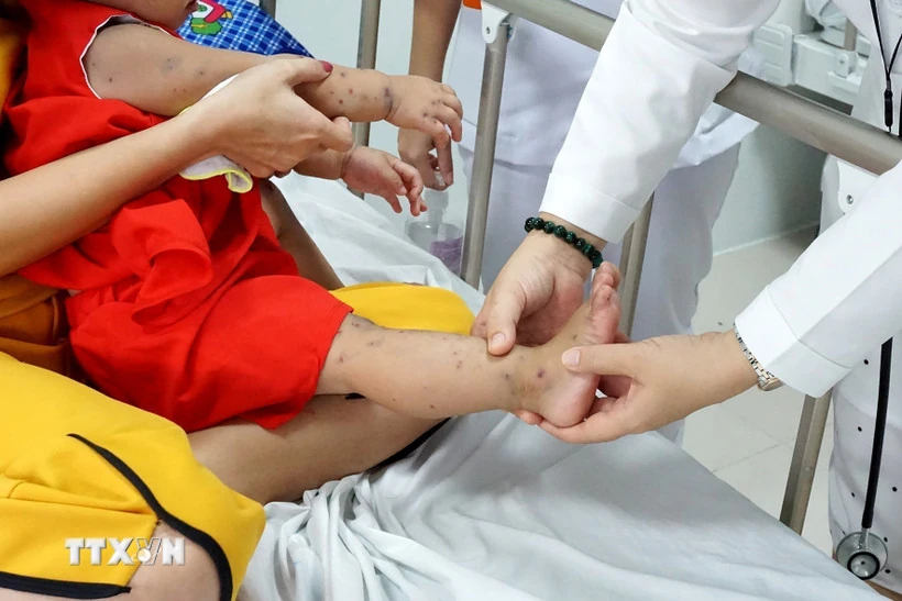 Yêu cầu tăng cường thu dung, điều trị khi ca mắc tay chân miệng tăng mạnh