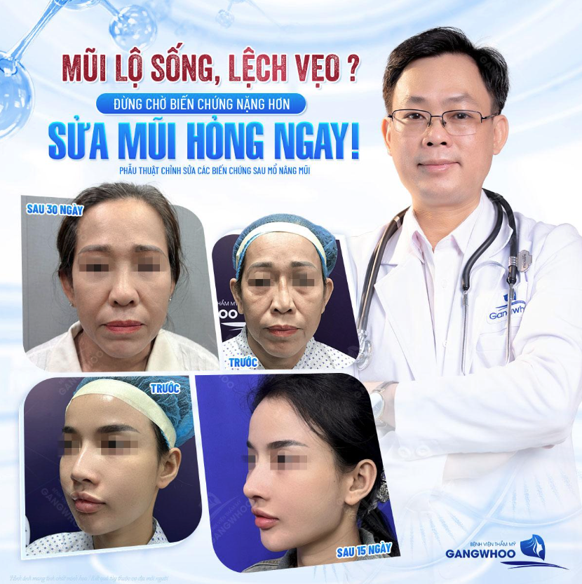 Bệnh viện thẩm mỹ Gangwhoo top địa chỉ sửa mũi hỏng tại TPHCM