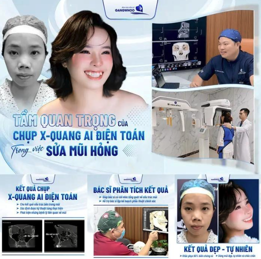 Bệnh viện thẩm mỹ Gangwhoo top địa chỉ sửa mũi hỏng tại TPHCM