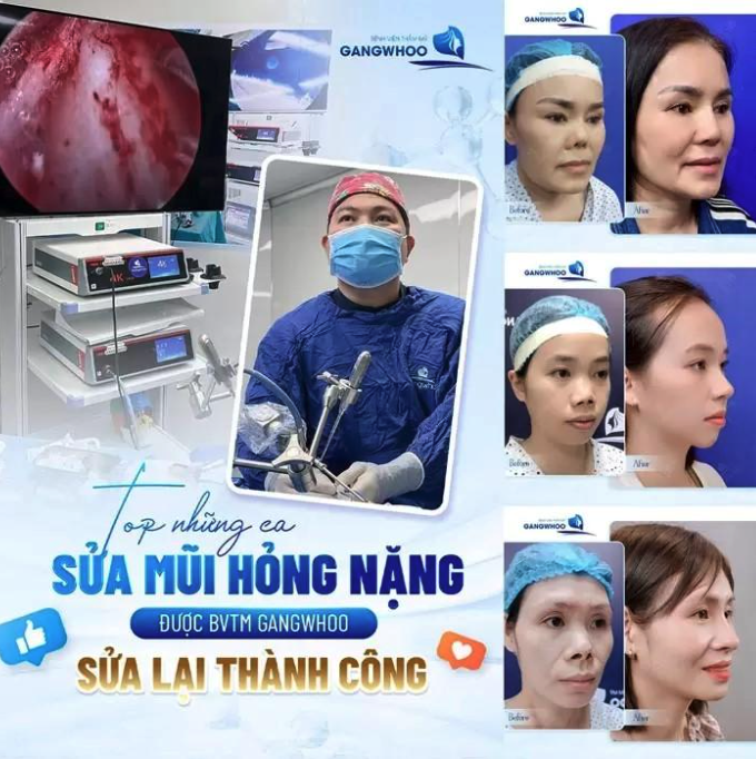 Bệnh viện thẩm mỹ Gangwhoo top địa chỉ sửa mũi hỏng tại TPHCM