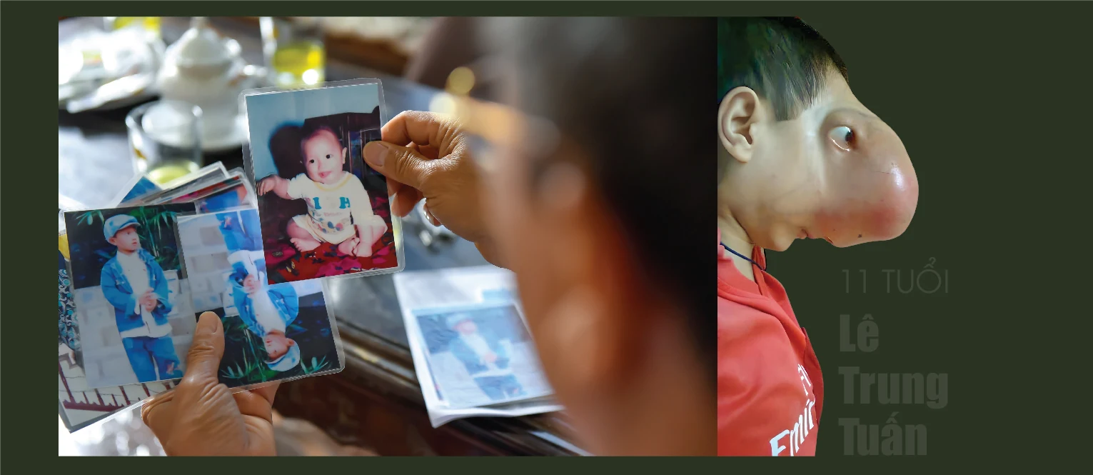 [E-Magazine] - Hành trình tìm lại dung nhan cho cậu bé “không có khuôn mặt”